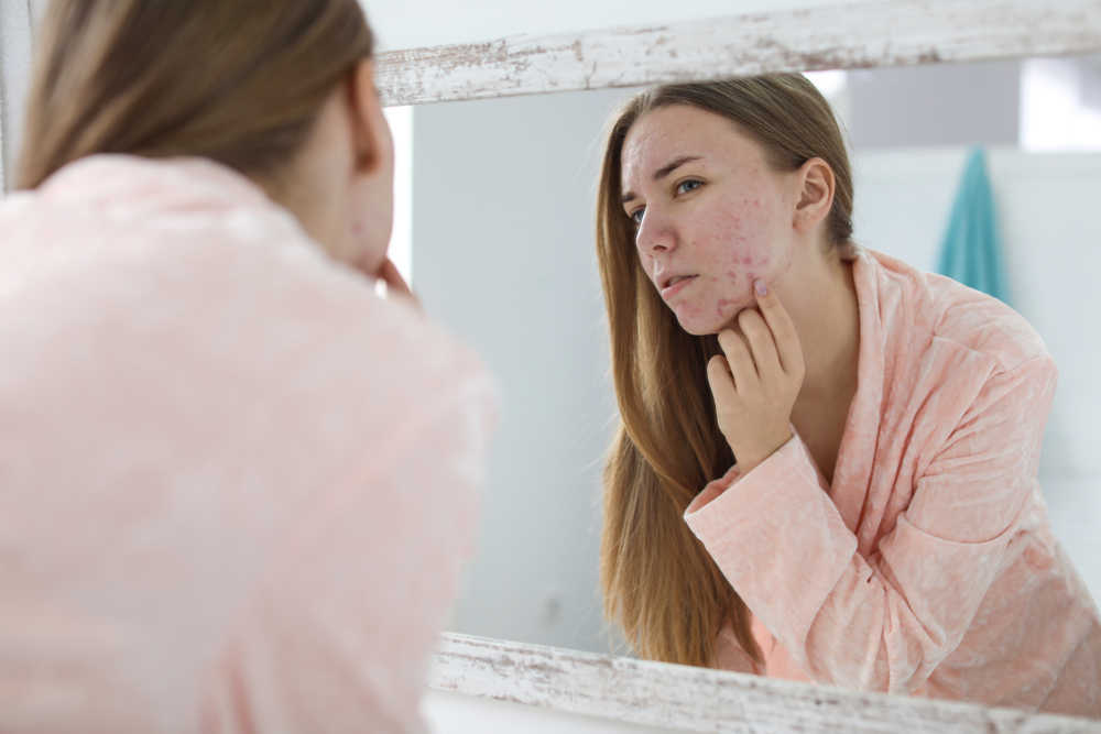 10 consejos para evitar y reducir el acné
